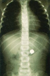 Ακτινογραφικών τομές