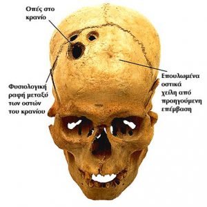 Τρυπανισμός